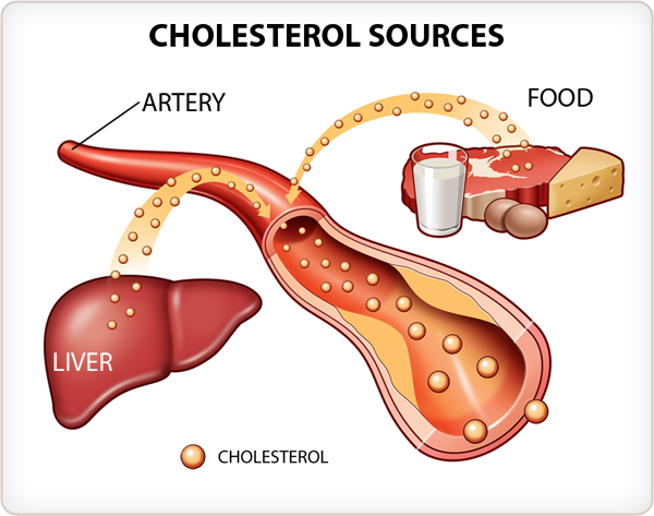 You Have High Cholesterol, Now what?