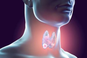 austin thyroid cancer